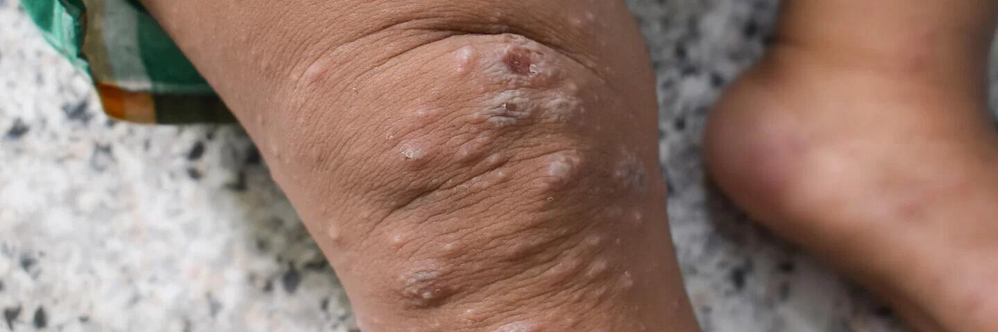 wie lange überlebt krätze in kleidung - Was machen mit Jacken bei Krätze