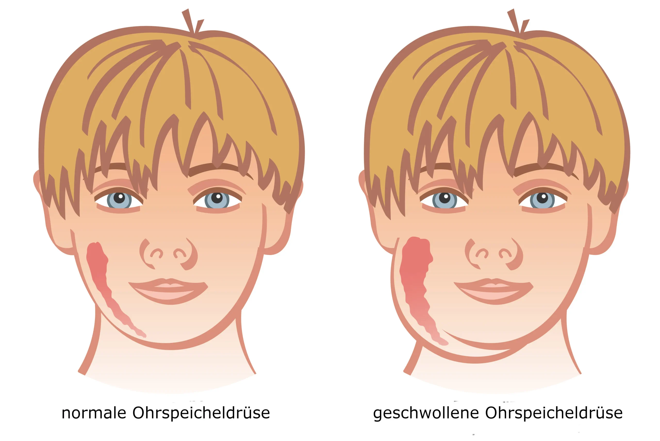 mumps behandlung - Was macht der Arzt bei Mumps