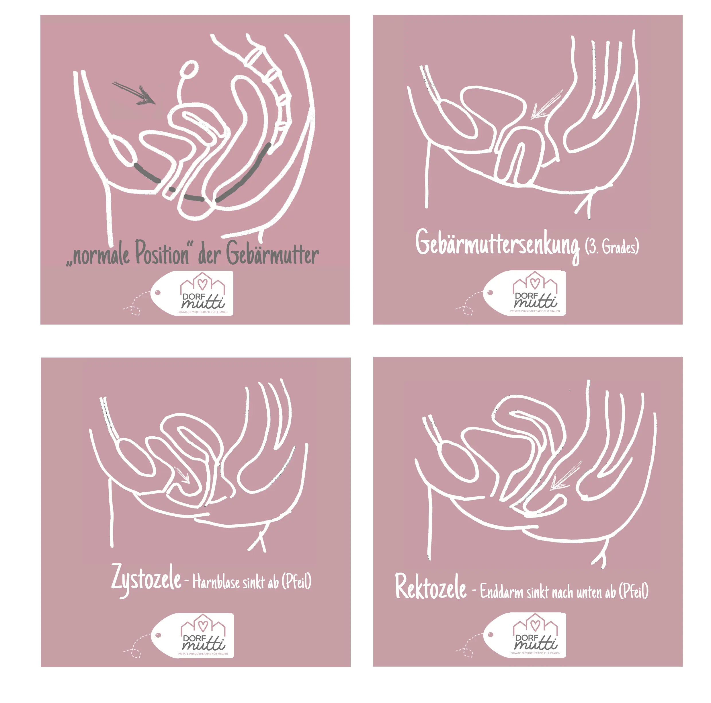 gebärmuttersenkung nach geburt erfahrung - Was macht Frauenarzt bei Gebärmuttersenkung