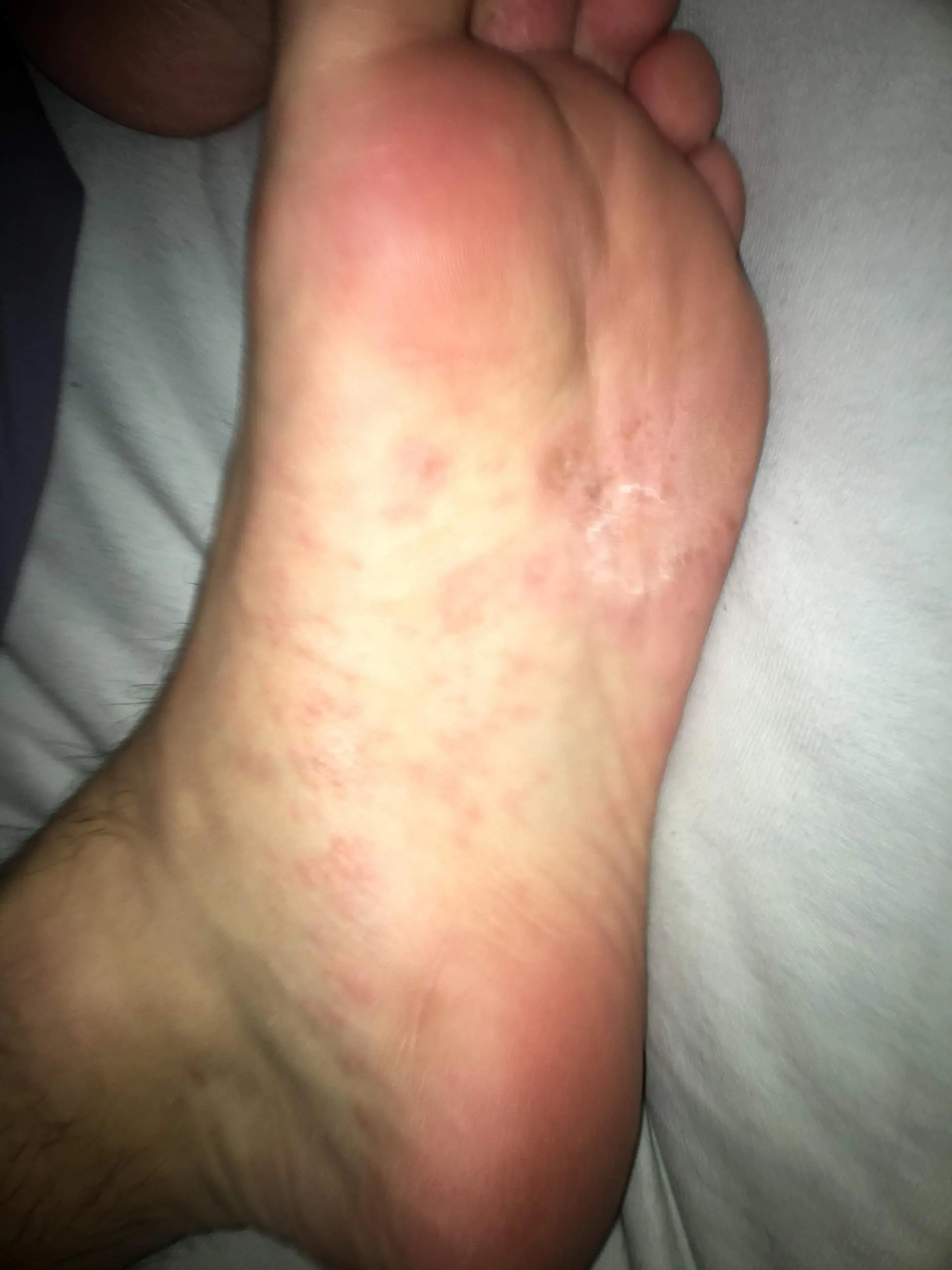 juckreiz fußsohle - Was macht man gegen juckende Fußsohlen