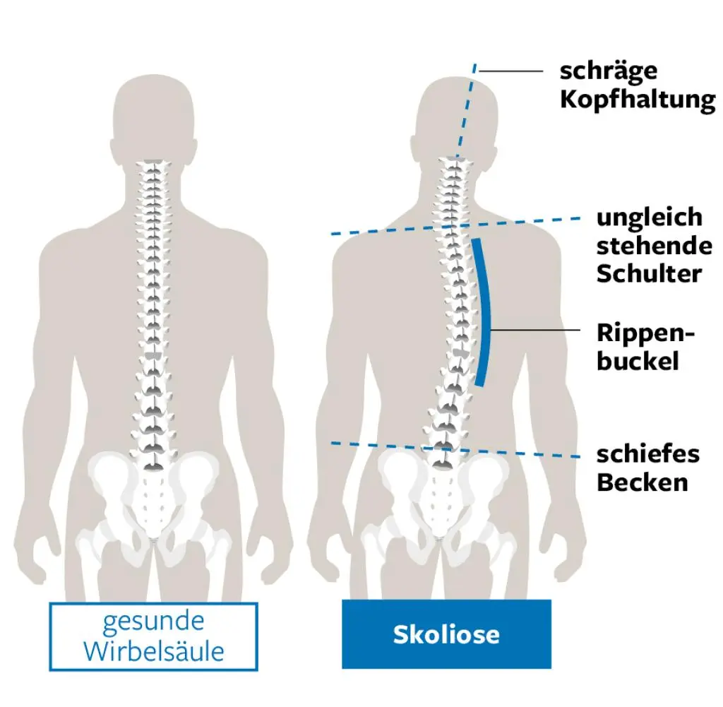 fehlstellung der wirbelsäule - Was macht man wenn die Wirbelsäule schief ist