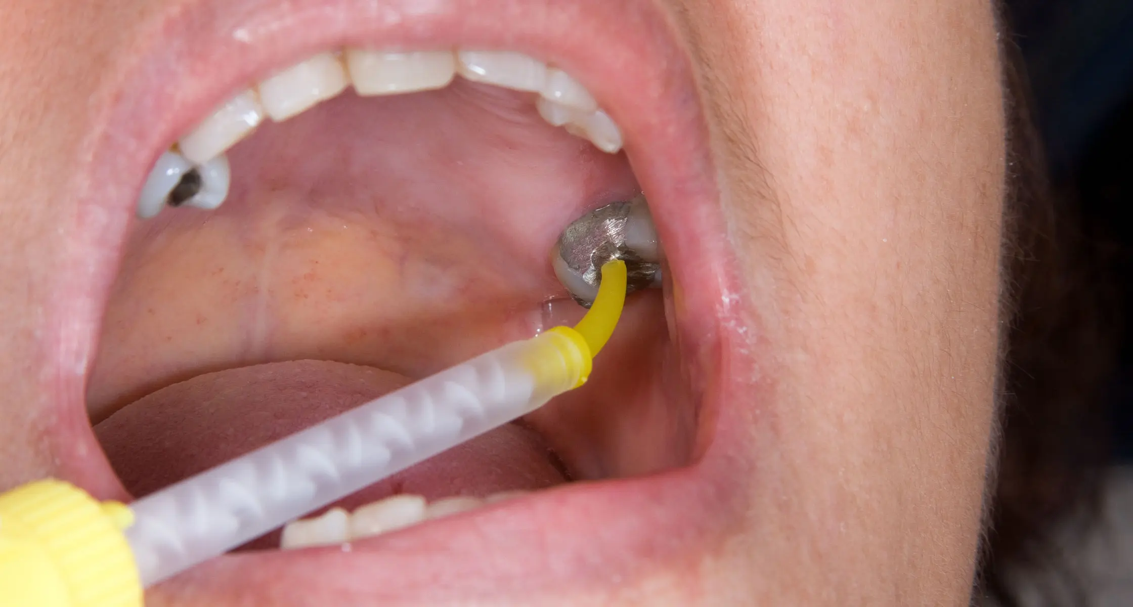 amalgam in der schwangerschaft - Was macht Quecksilber in der Schwangerschaft