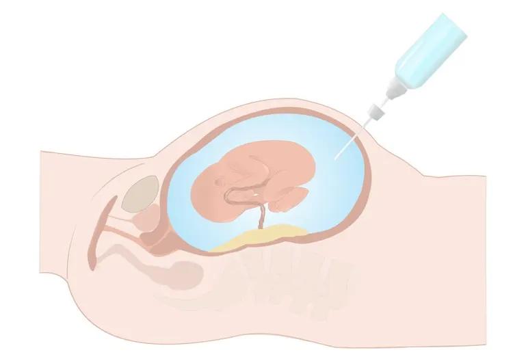 wie lange fehlgeburtsrisiko nach fruchtwasseruntersuchung - Was muss ich nach der Fruchtwasseruntersuchung beachten