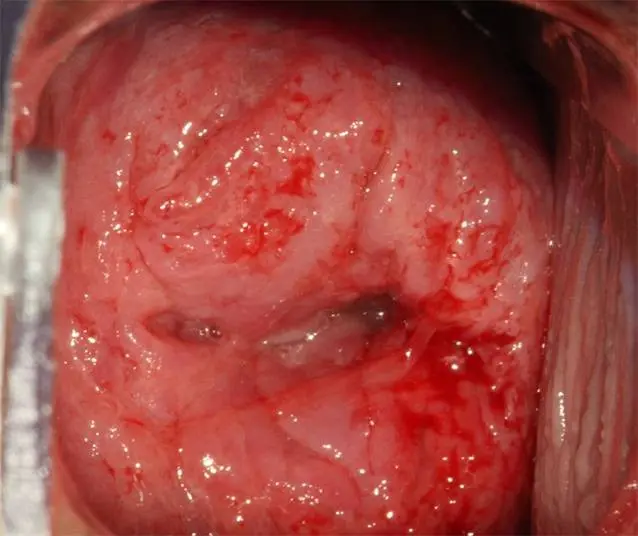 kolposkopie schwangerschaft - Was muss ich nach einer Kolposkopie beachten