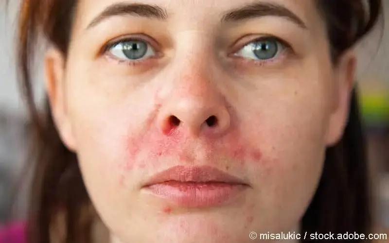 periorale dermatitis schwangerschaft - Was nicht essen bei perioraler Dermatitis