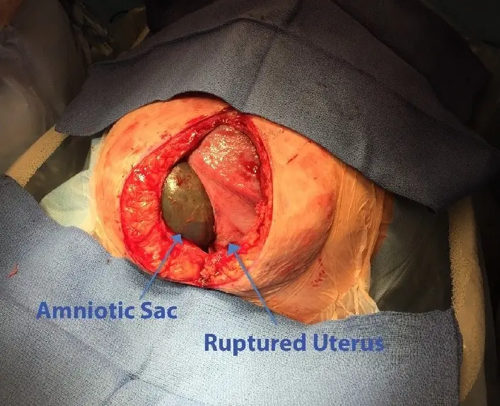uterus ruptur - Was passiert bei einer Ruptur