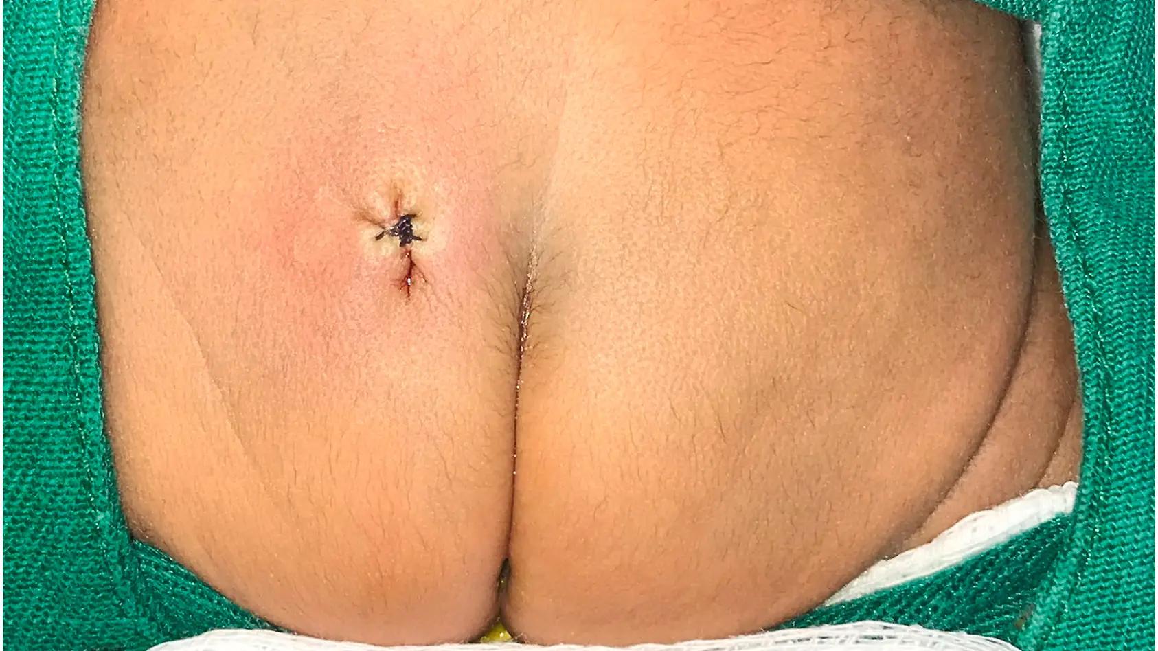 loch am steißbein seit geburt - Was passiert bei Spina bifida