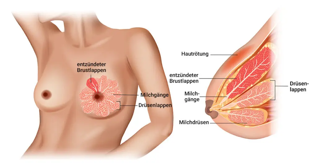 mastitis schwangerschaft behandlung - Was passiert bei unbehandelter Mastitis