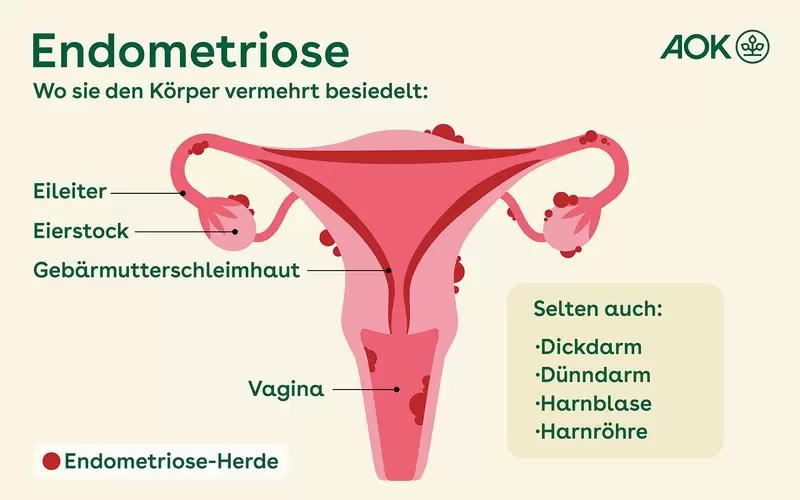 warum unterleibsschmerzen - Was passiert bei Unterleibsschmerzen