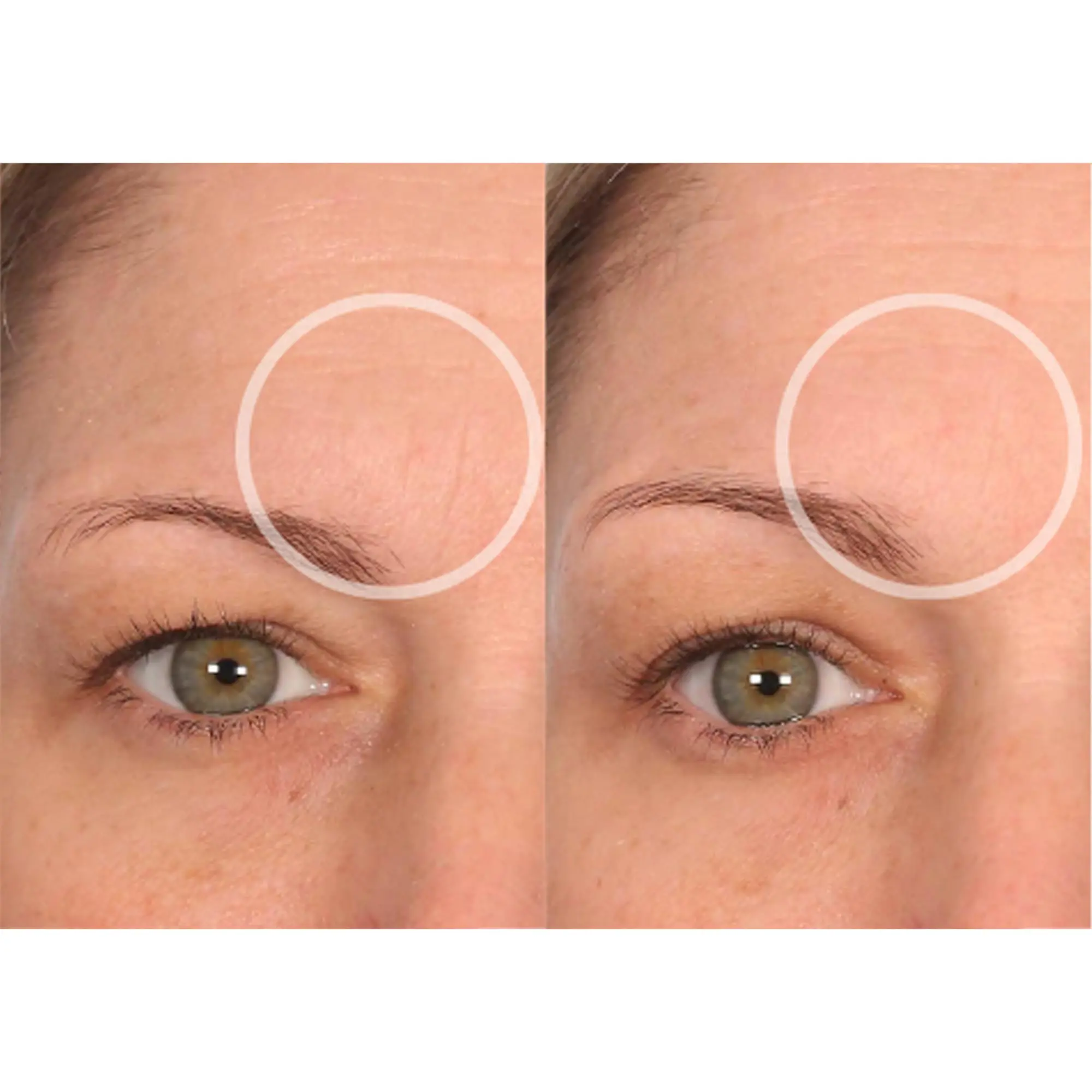 brow lift schwangerschaft - Was passiert beim Browlifting