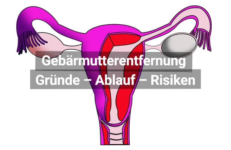 Gebärmutterentfernung nach der Geburt: Was Sie wissen sollten - Was passiert mit meinem Körper nach einer Gebärmutterentfernung gebärmutterentfernung nach geburt - Was passiert mit meinem Körper nach einer Gebärmutterentfernung