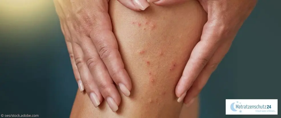 gepflegte scabies - Was passiert mit toten Krätzemilben