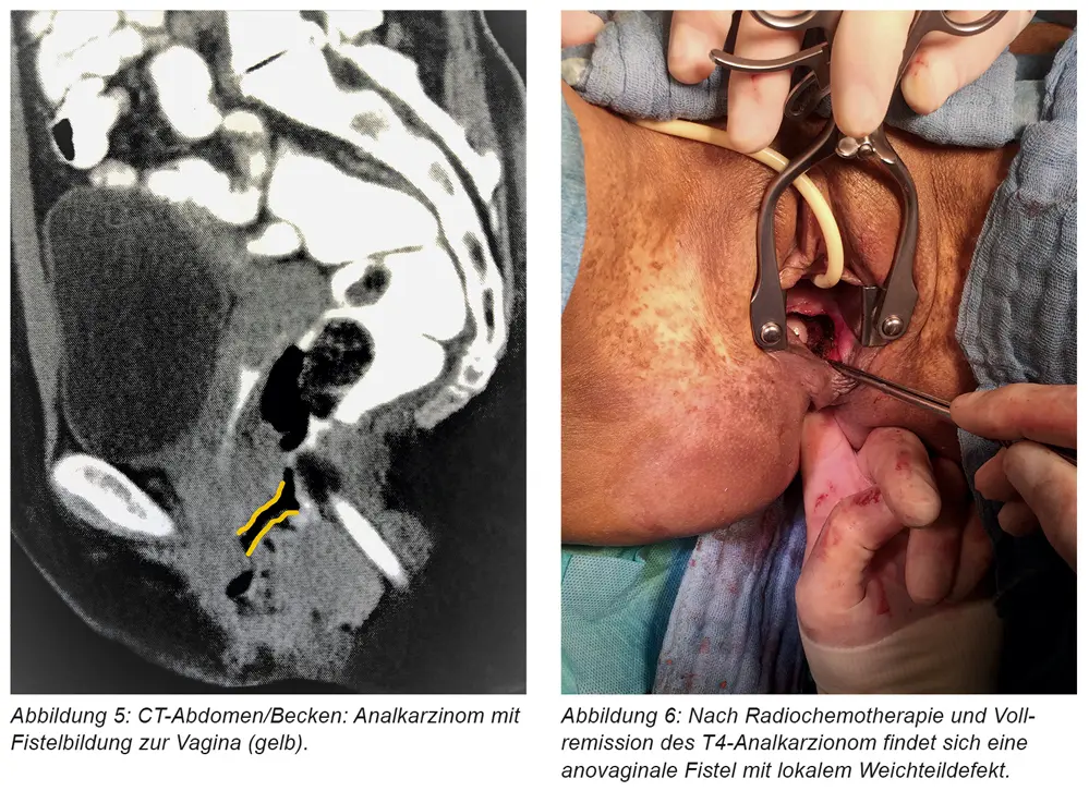 fistel schwangerschaft - Was passiert mit unbehandelten Fisteln