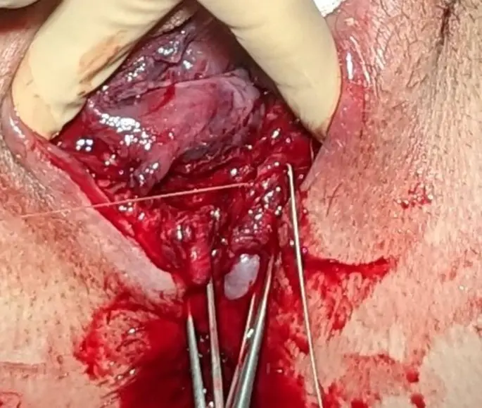 dammriss geburt - Was passiert wenn der Damm reißt