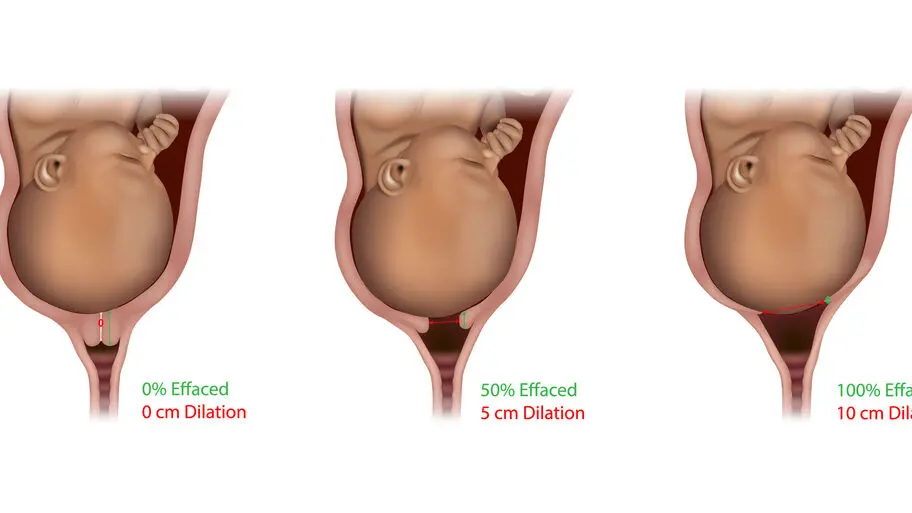 gebärmutterhals verstrichen wie lange bis zur geburt - Was passiert wenn der Gebärmutterhals verstrichen ist
