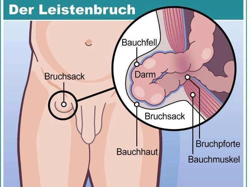 Bauchdeckenriss: Ursachen, Symptome und Behandlung - Was passiert wenn die Bauchdecke reisst bauchdecke riss - Was passiert wenn die Bauchdecke reisst