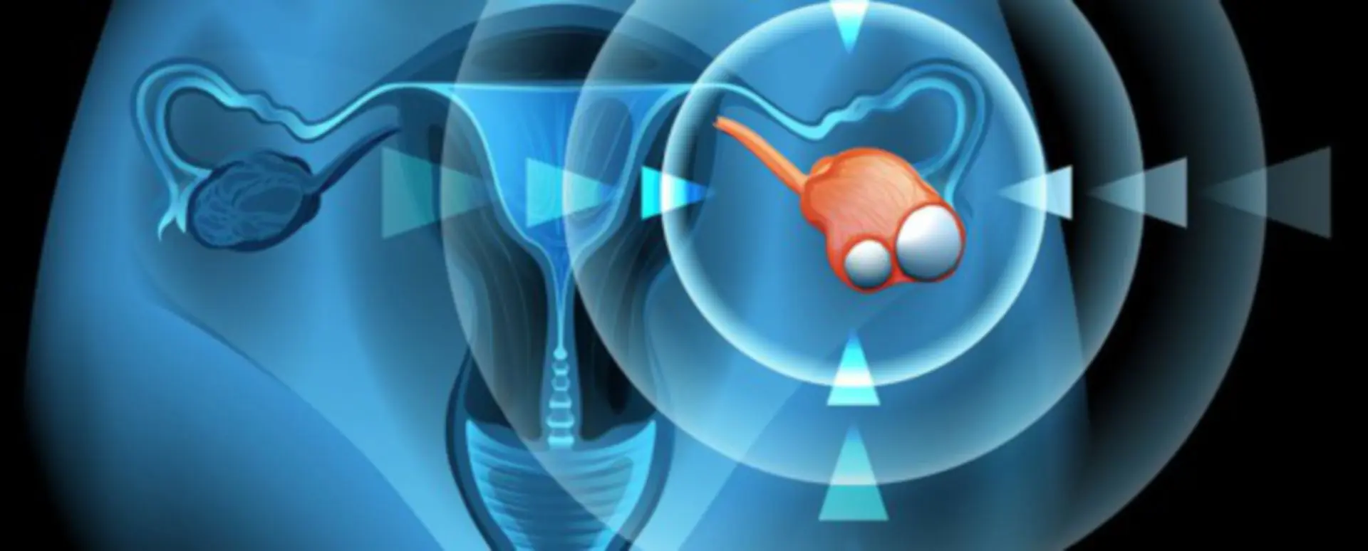 nur ein eierstock von geburt an - Was passiert wenn ein Eierstock fehlt