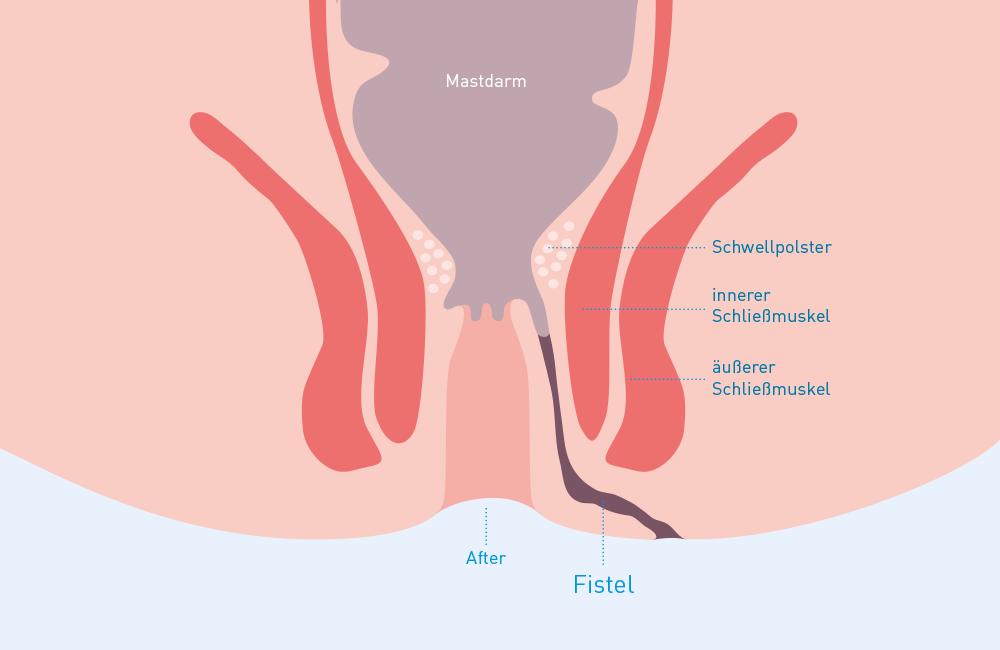 fistel schwangerschaft - Was passiert wenn eine Fistel nicht behandelt wird