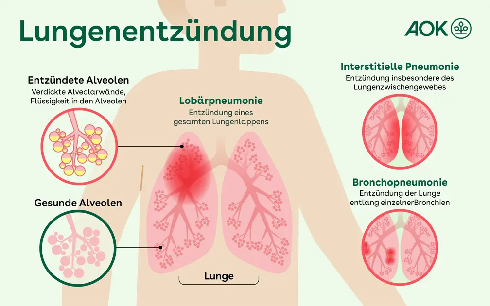 verschleppte lungenentzündung symptome - Was passiert wenn eine Lungenentzündung verschleppt wird