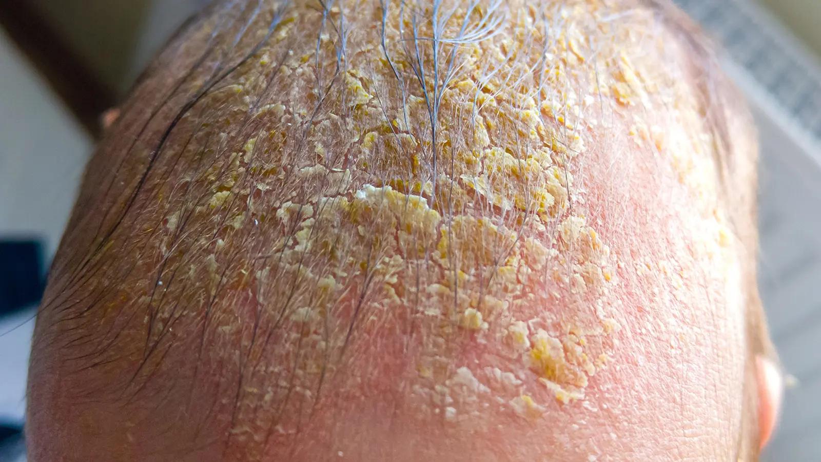 kopfgneis gesicht - Was passiert wenn man Kopfgneis nicht entfernen