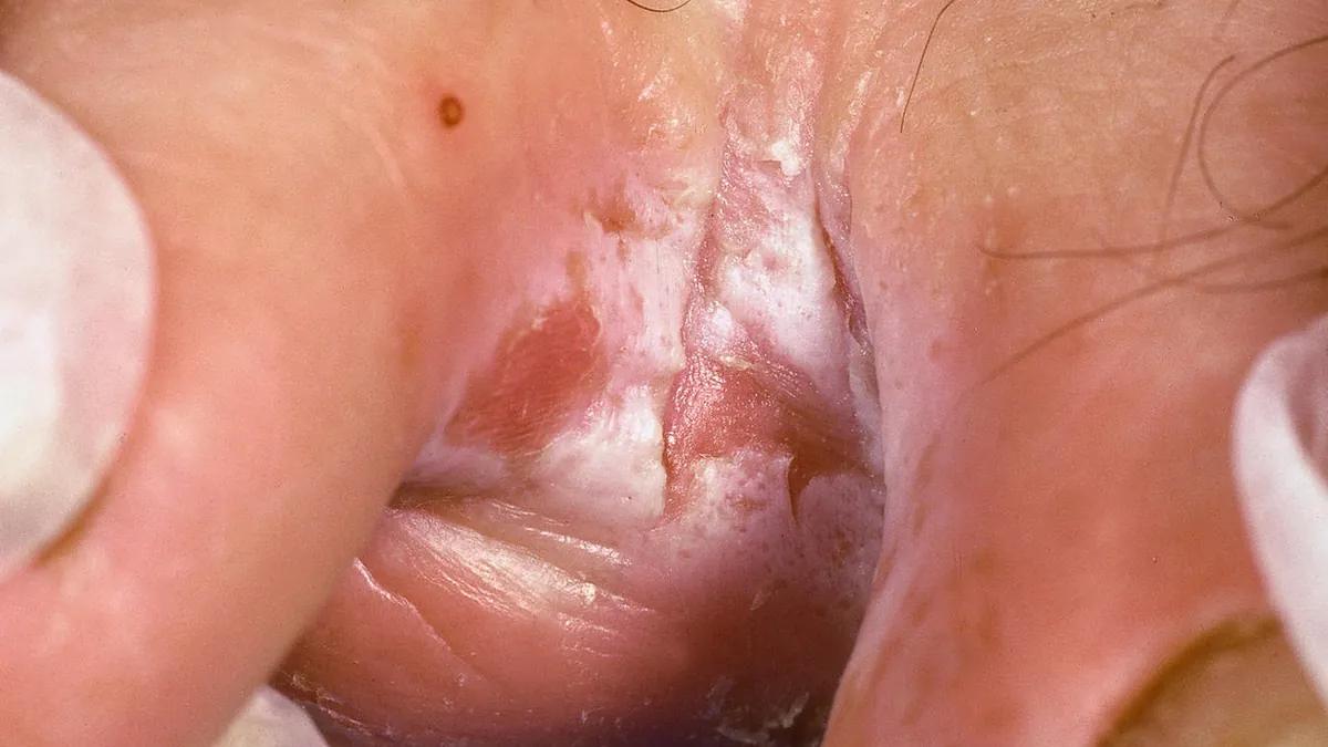 leistenpilz schwangerschaft - Was passiert wenn man Leistenpilz nicht behandelt