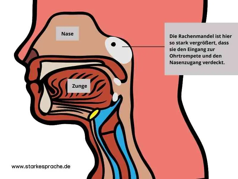 polypen vergrößert - Was passiert wenn man Polypen nicht entfernen lässt