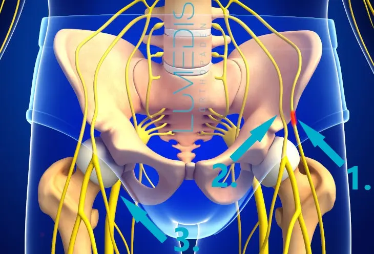 meralgia paraesthetica schwangerschaft - Was passiert wenn Meralgia paraesthetica nicht behandelt wird