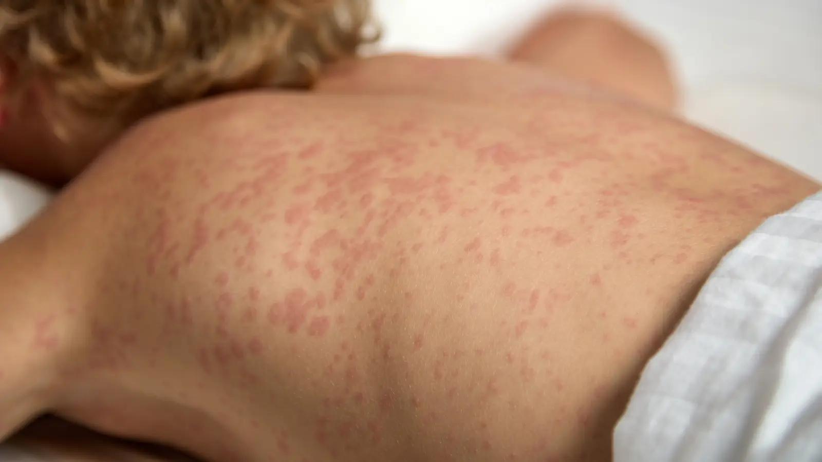 scharlach ausschlag juckt - Was sieht ähnlich aus wie Scharlach