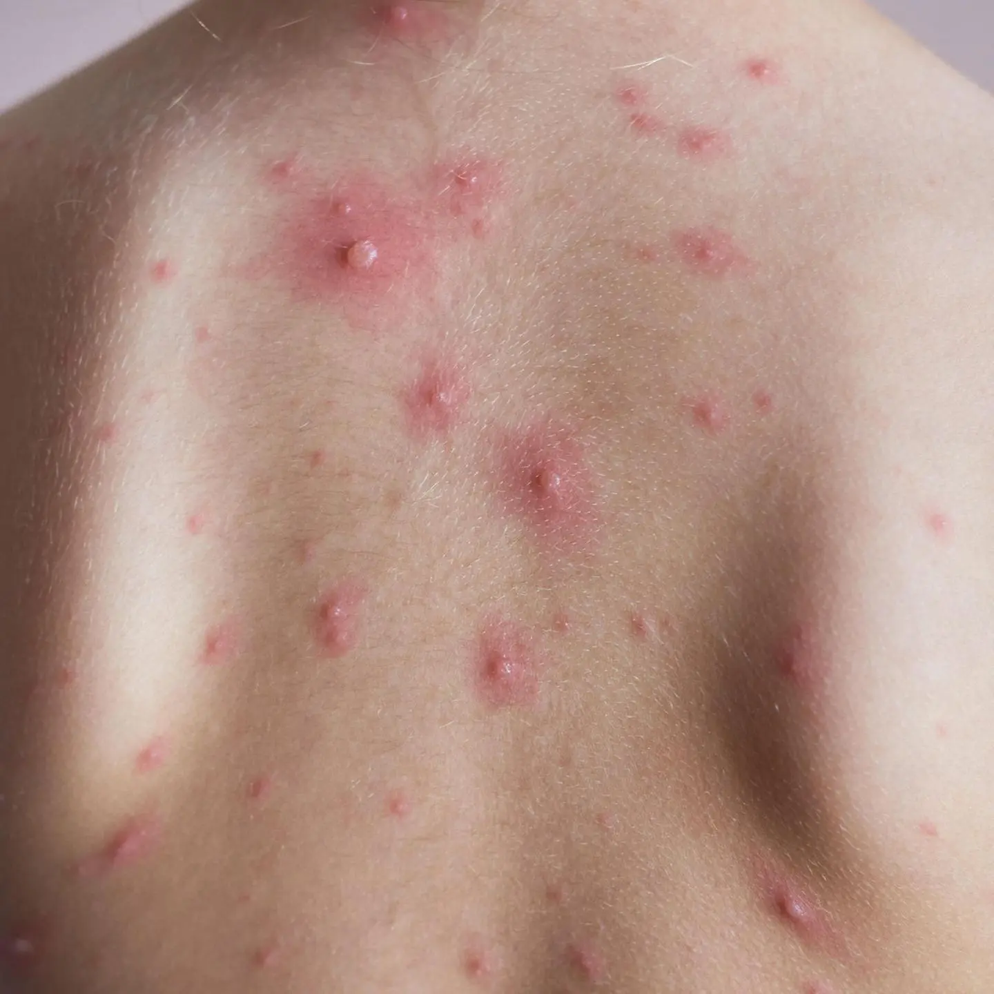 Pocken bei Kindern: Symptome, Behandlung und Vorbeugung - Was sind Anzeichen für Pocken pocken bei kindern - Was sind Anzeichen für Pocken