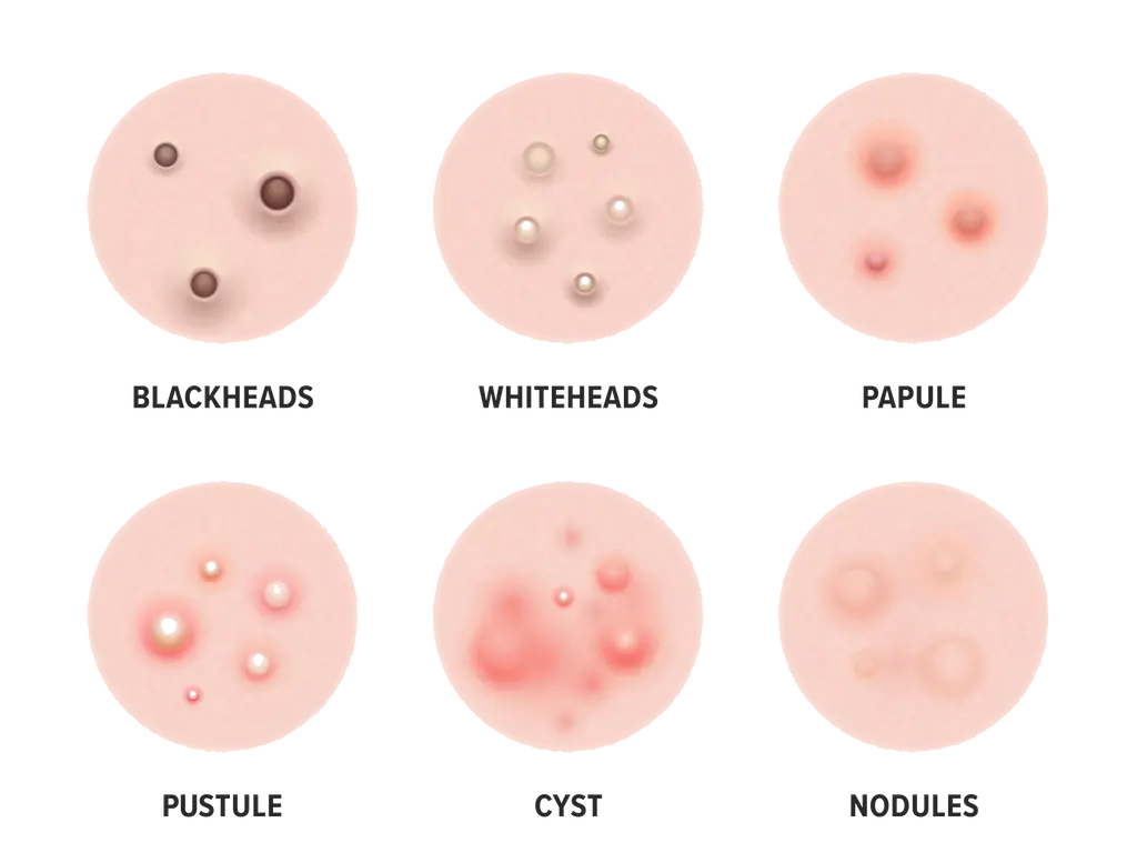 Weiße Pickel: Ursachen, Behandlung und Vorbeugung - Was sind kleine weiße pickelchen im Gesicht weiße pickel - Was sind kleine weiße pickelchen im Gesicht