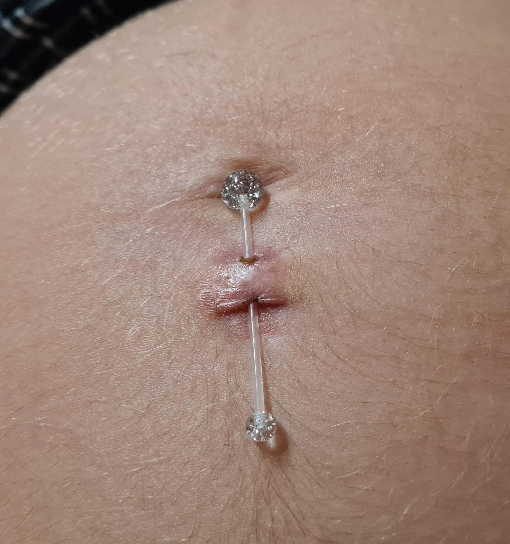bauchnabelpiercing entzündet schwangerschaft - Was soll man machen wenn das Bauchnabelpiercing entzündet ist