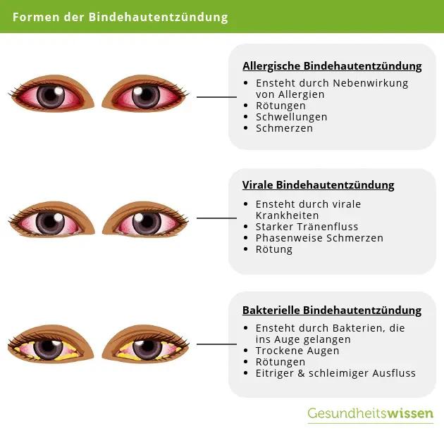 bindehautentzündung schwangerschaft hausmittel - Was sollte man bei einer Bindehautentzündung nicht tun