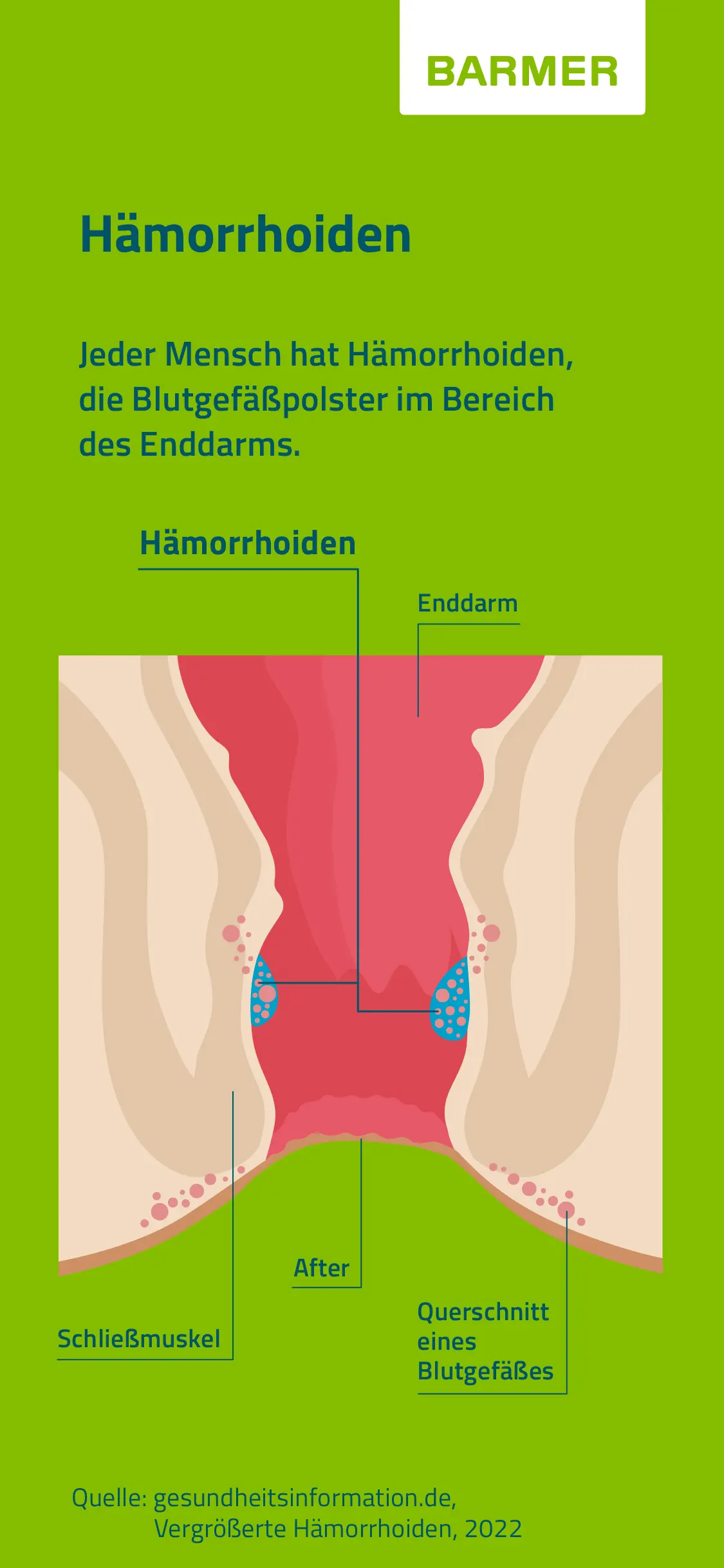 Hämorrhoiden Jucken: Was Tun? - Was sollte man bei Hämorrhoiden nicht tun hämorrhoiden jucken was tun - Was sollte man bei Hämorrhoiden nicht tun