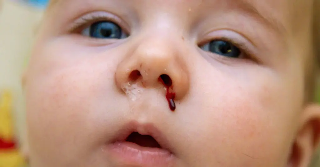 nasenbluten kleinkinder - Was sollte man bei Nasenbluten nicht machen
