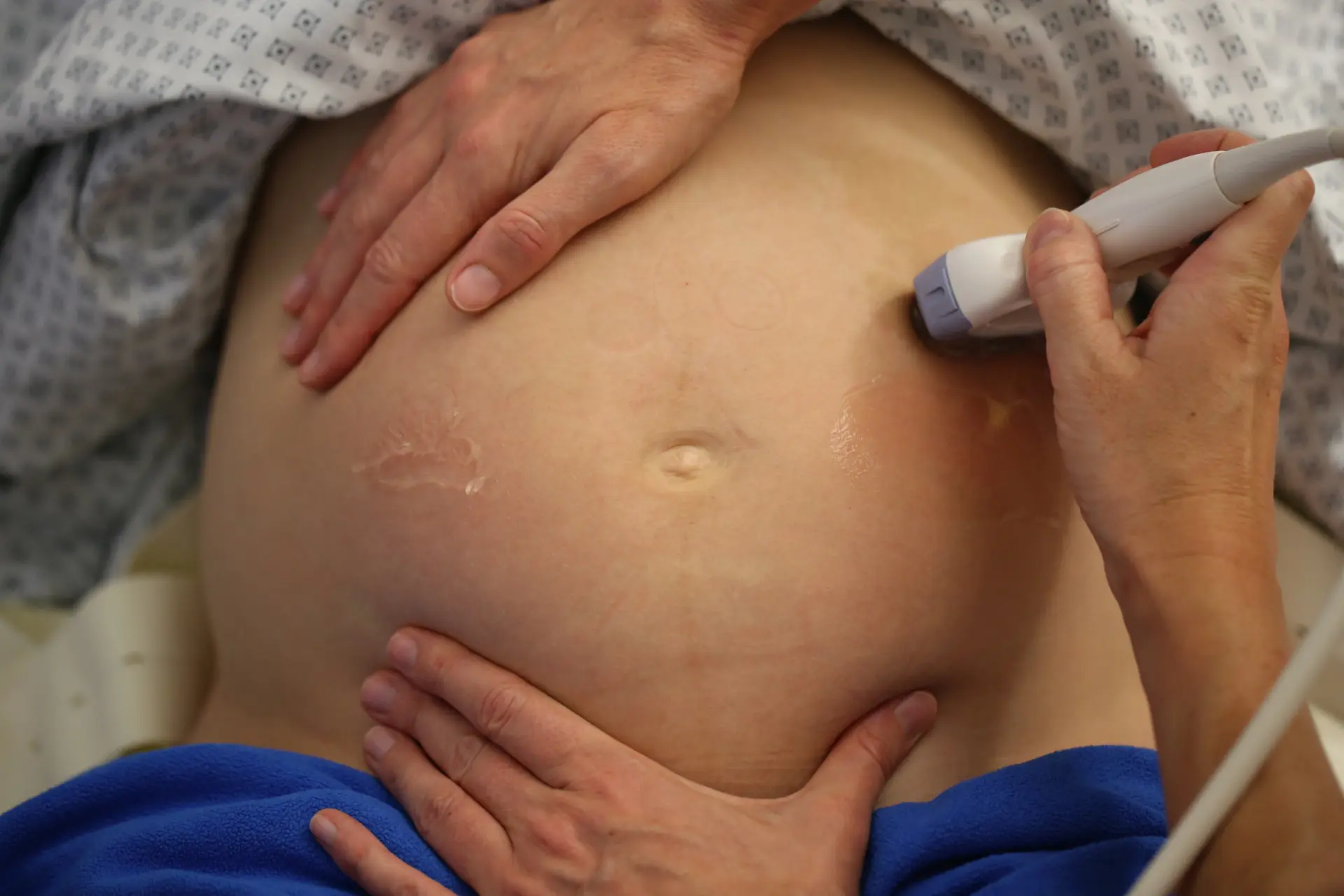 Geburt Äußere Wendung: Alles, was Sie wissen müssen - Was spricht gegen äußere Wendung geburt äußere wendung - Was spricht gegen äußere Wendung