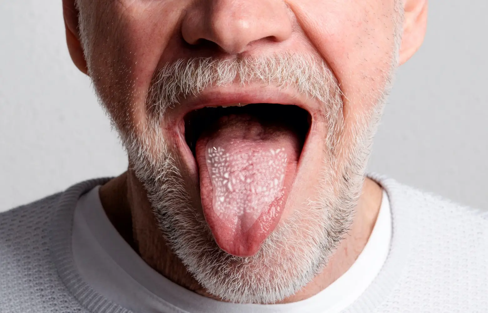 mundpilz mundsoor hausmittel - Was tötet Pilze im Mund ab