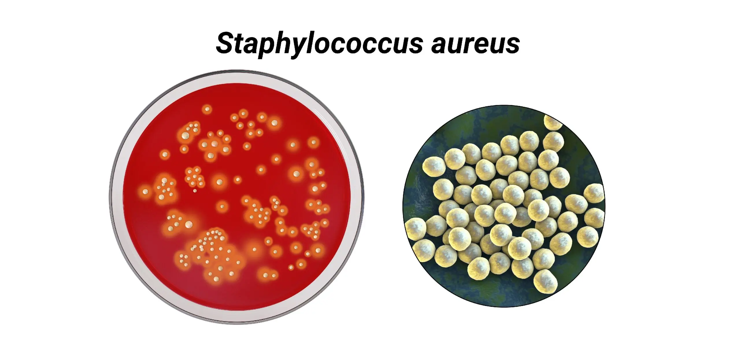 staphylococcus aureus hausmittel - Was tötet Staphylococcus aureus ab