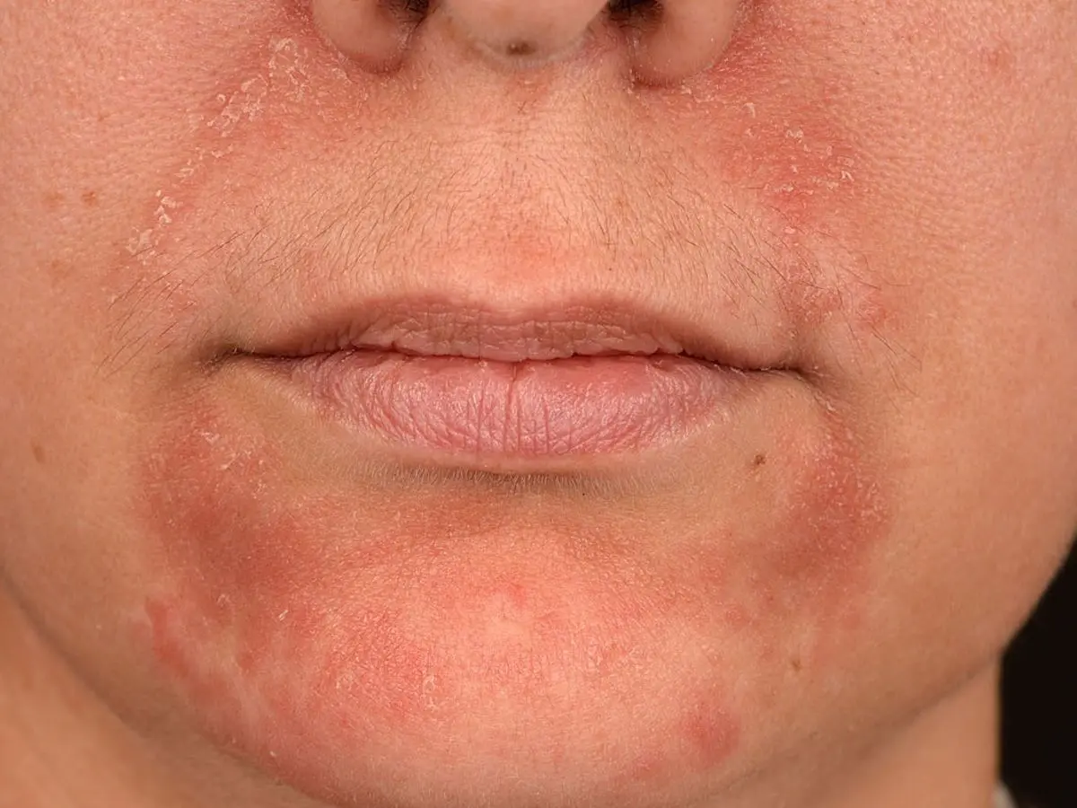 periorale dermatitis schwangerschaft - Was triggert periorale Dermatitis