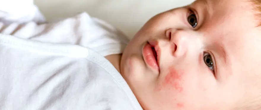 allergische reaktion haut kind was tun - Was tun bei allergischer Reaktion Haut Kind