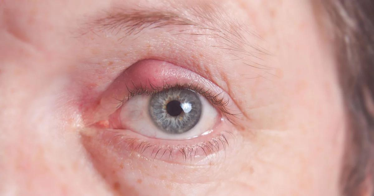 beule auf augenlid - Was tun bei Beule am Auge