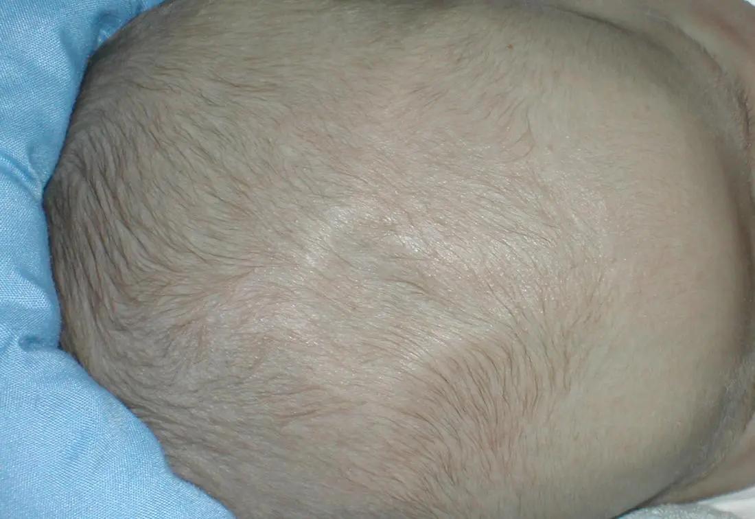 fontanelle baby eingesunken - Was tun bei Eingesunkener Fontanelle