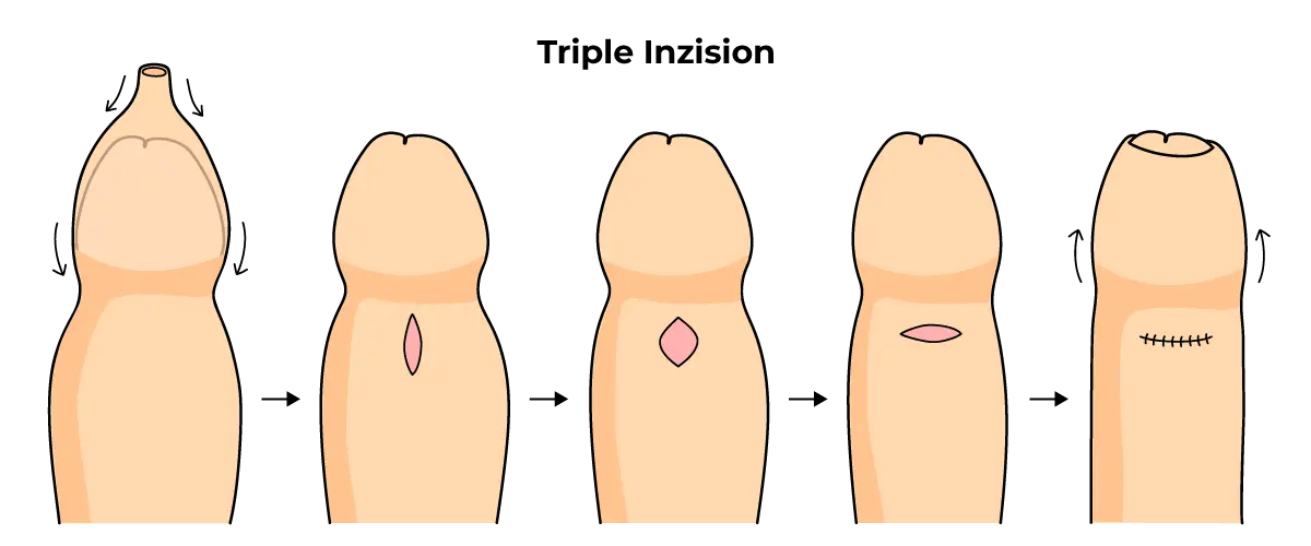 vorhaut entzündet kind wann zum arzt - Was tun bei entzündeter Vorhaut Kinder