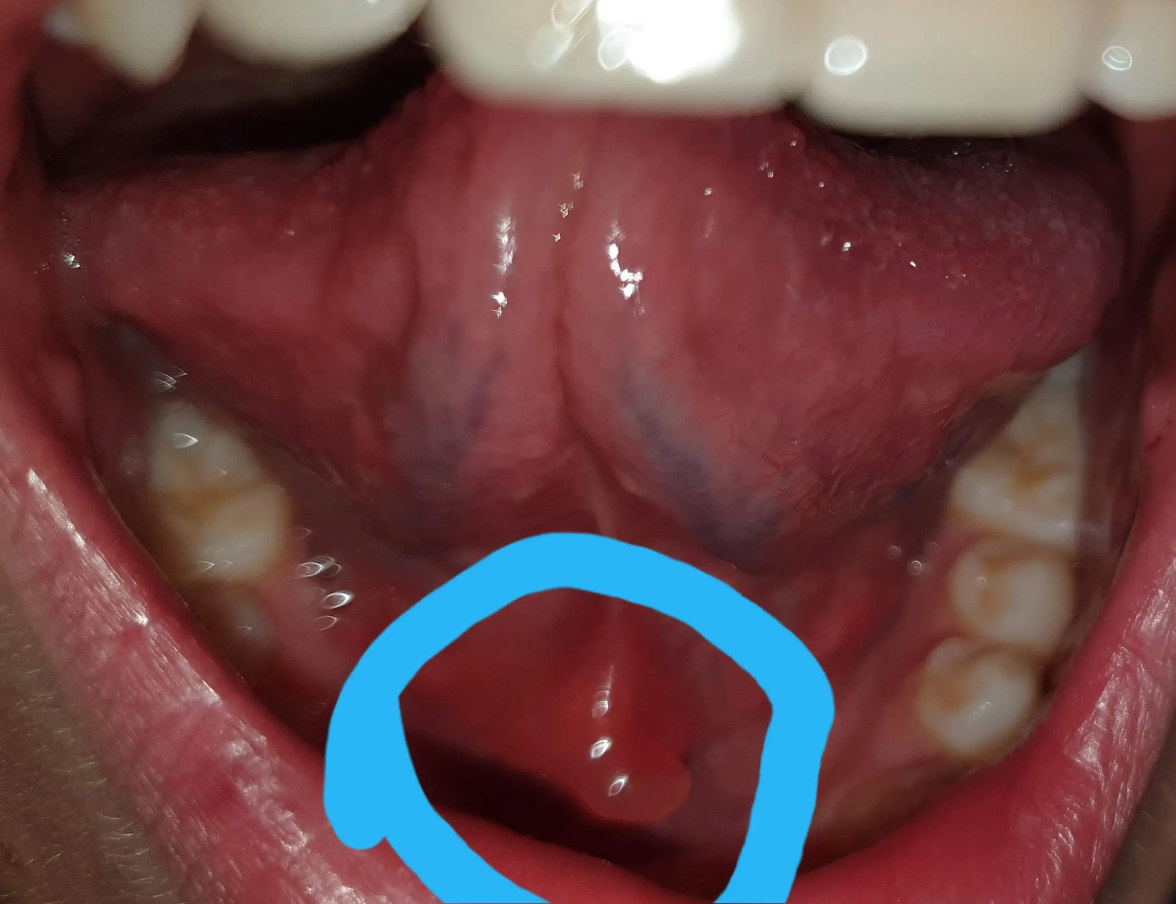 zungenbändchen entzündet was tun - Was tun bei Entzündung unter der Zunge