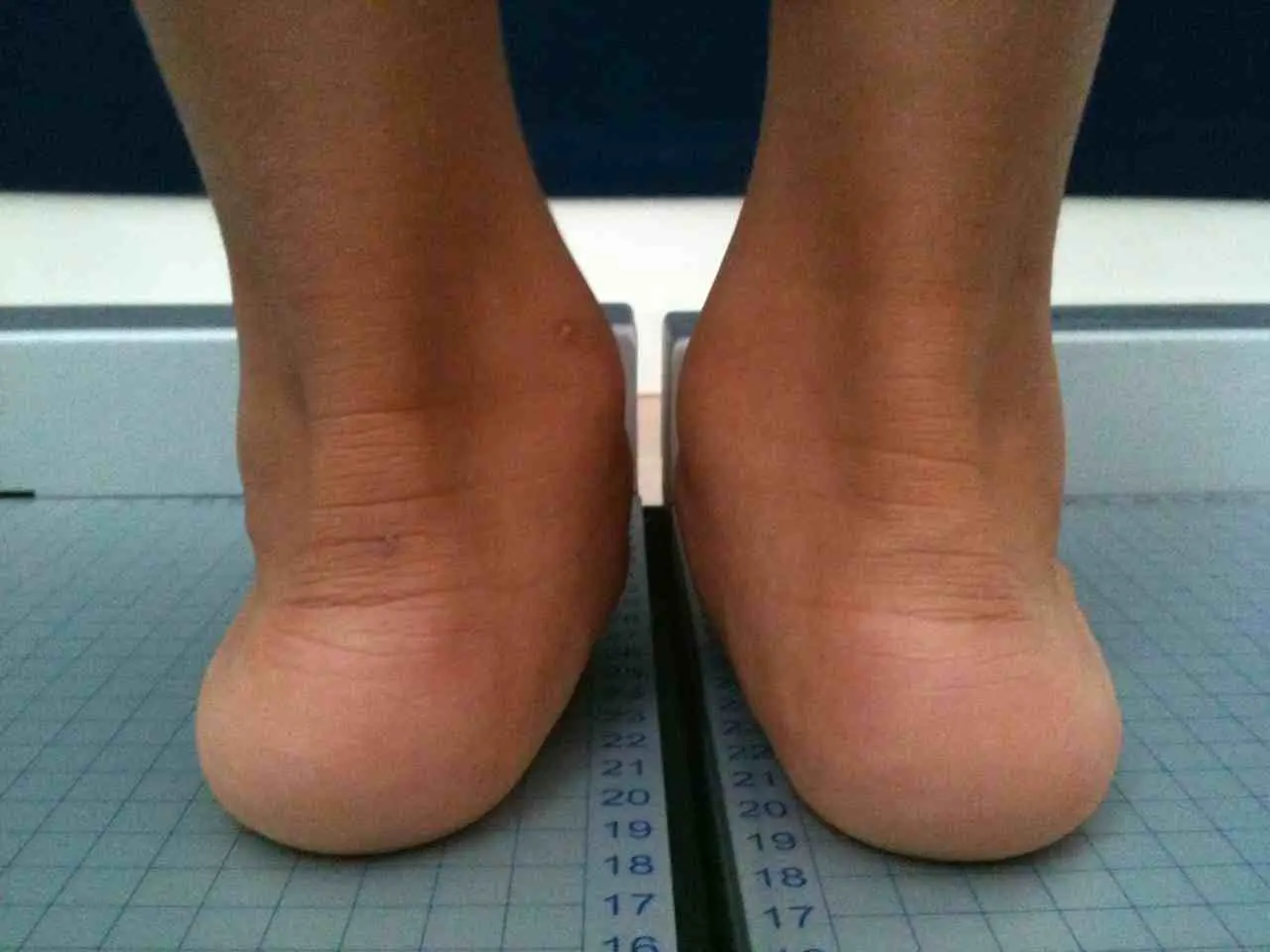 fußfehlstellung bei kleinkindern - Was tun bei Fußfehlstellung Kind