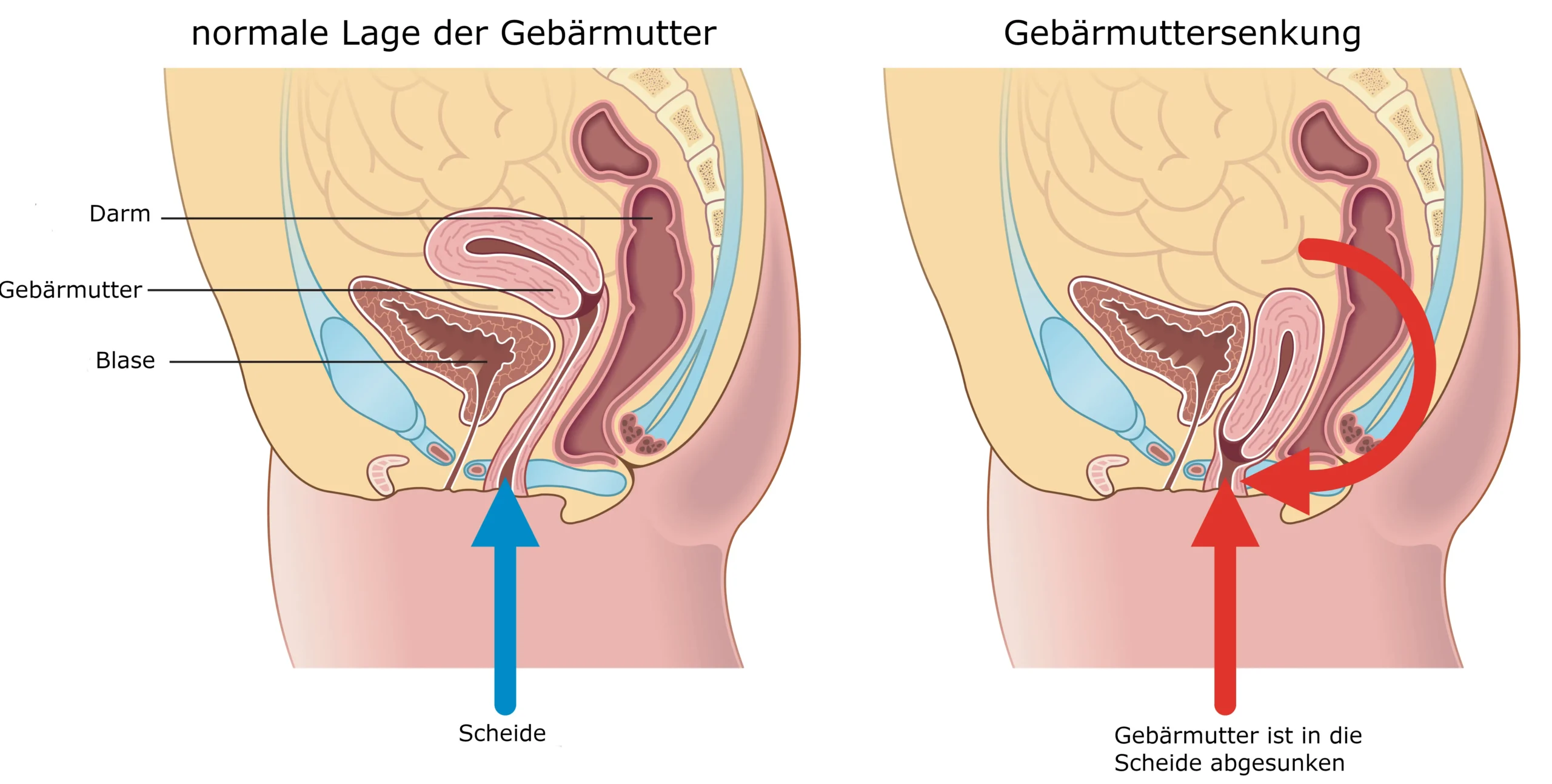 gebärmuttersenkung nach geburt - Was tun bei Gebärmuttersenkung nach Geburt