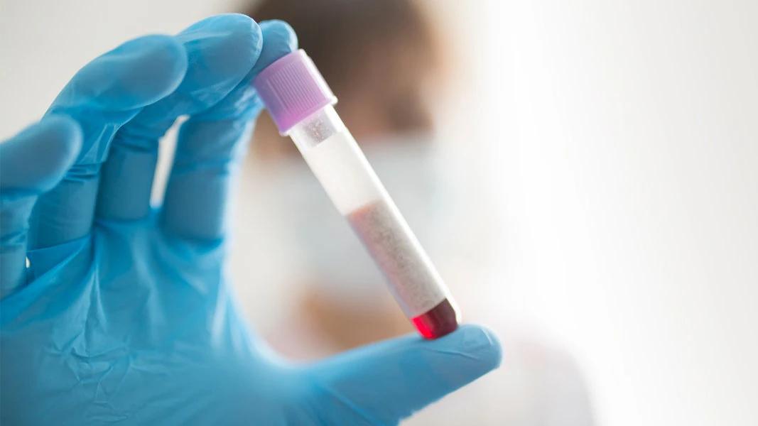 Cholesterin erhöht nach Geburt: Ursachen, Risiken und Behandlungsmöglichkeiten - Was tun bei genetisch bedingten hohen Cholesterin cholesterin erhöht nach geburt - Was tun bei genetisch bedingten hohen Cholesterin