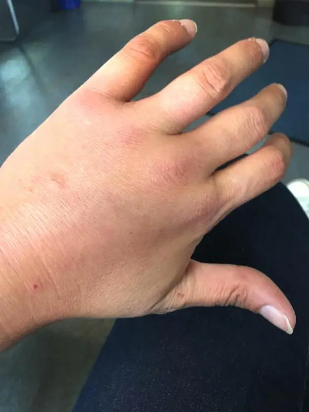insektenstich hand geschwollen - Was tun bei geschwollener Hand durch Insektenstich