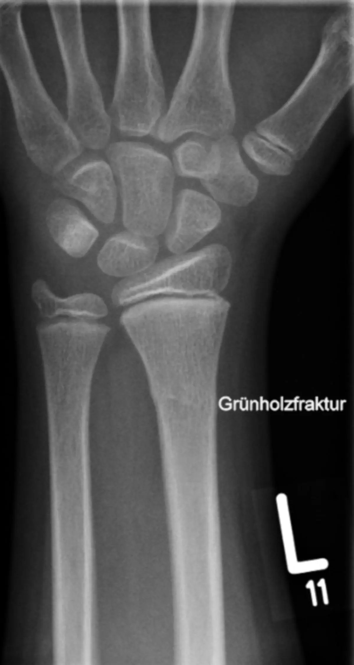 grünholz fraktur - Was tun bei Grünholzfraktur