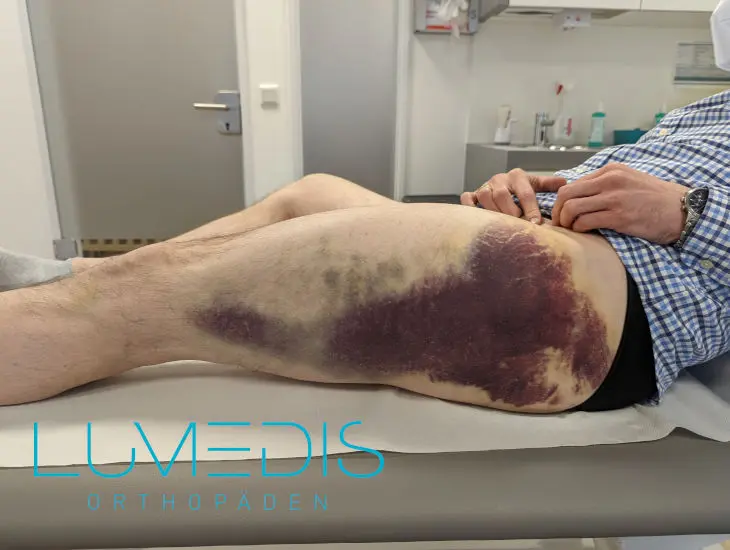 Hämatom nach Operation: Ursachen, Behandlung und Tipps - Was tun bei Hämatom nach OP hämatom nach geburt op - Was tun bei Hämatom nach OP