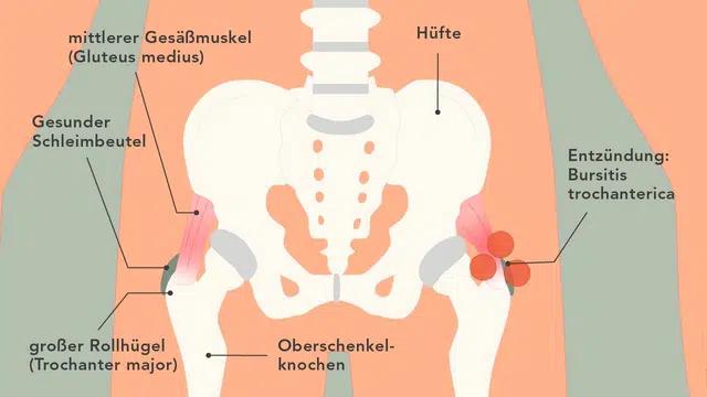 nächtliche hüftschmerzen schwangerschaft - Was tun bei Hüftschmerzen beim schlafen